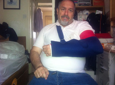 Broken arm